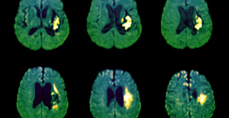 Increased SBP prior to onset of OAC related to the risk of hemorrhagic stroke in AF