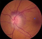 Non-arteritic anterior ischemic optic neuropathy: a case study