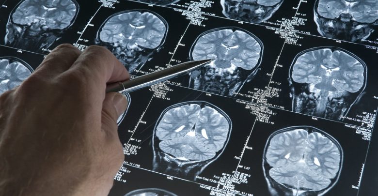 MRI-based subtypes of MS in the brain predict disability progression and response to treatment