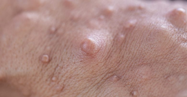 Predictive models for clinical features associated with pediatric neurofibromatosis type 1