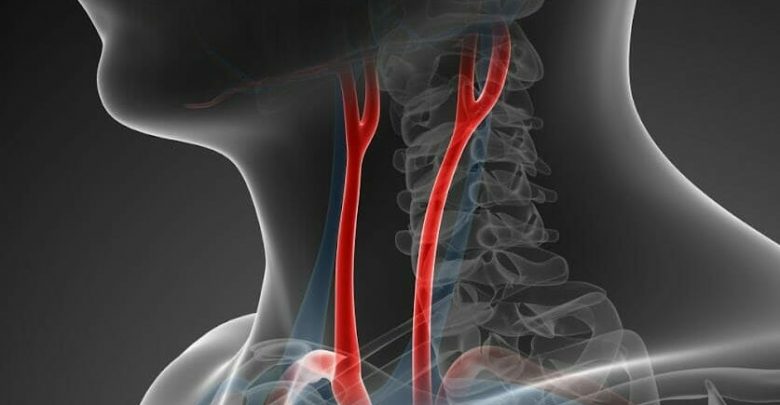 Carotid Web increases the risk of a recurring stroke | DAILYZ HEALTH NEWS