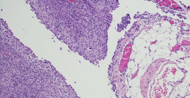 Checkpoint inhibitor-linked mononeuritis multiplex in patients with mesothelioma