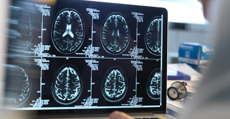 Hospital mortality, unfavorable neurological results with a high degree of subarachnoid hemorrhage of poor degree