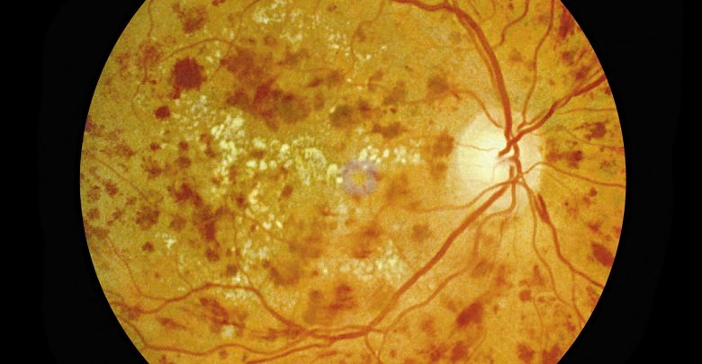 Withdrawal from treatments for diabetic retinopathy can increase neovascularization