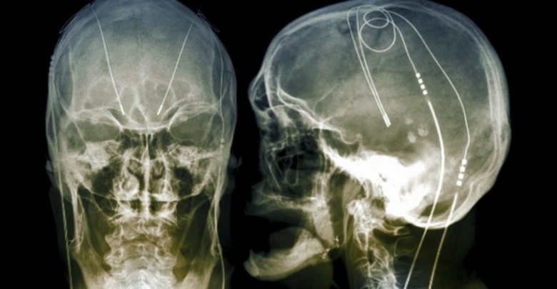 Safety, Feasibility of Postoperative Home Health Deep Brain Stimulation in PD
