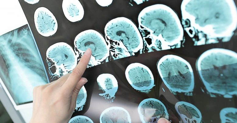 Fluid therapy after traumatic brain injury