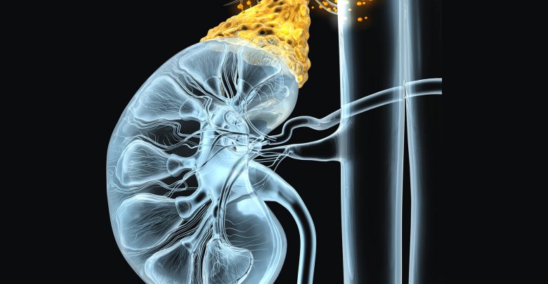 An Underdiagnosed Cause of Resistant Hypertension
