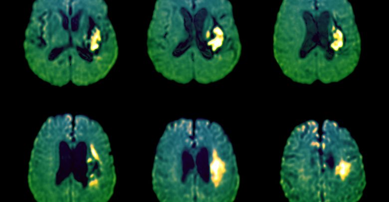 stroke, TIA, hemorrhagic stroke, hematoma