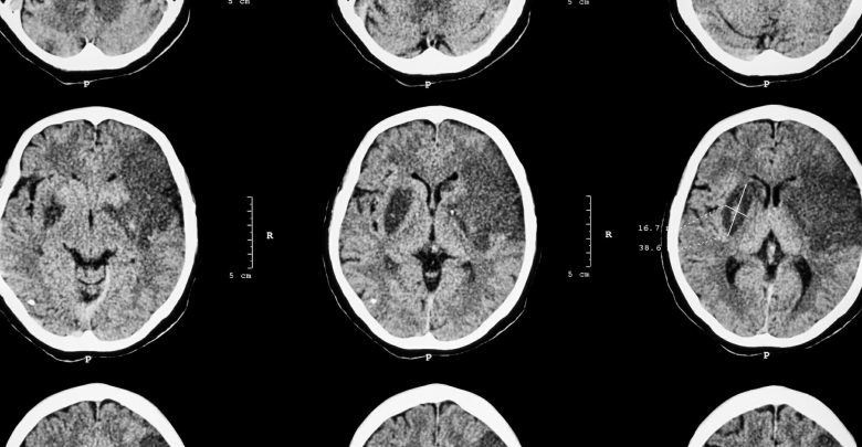 ischemic stroke