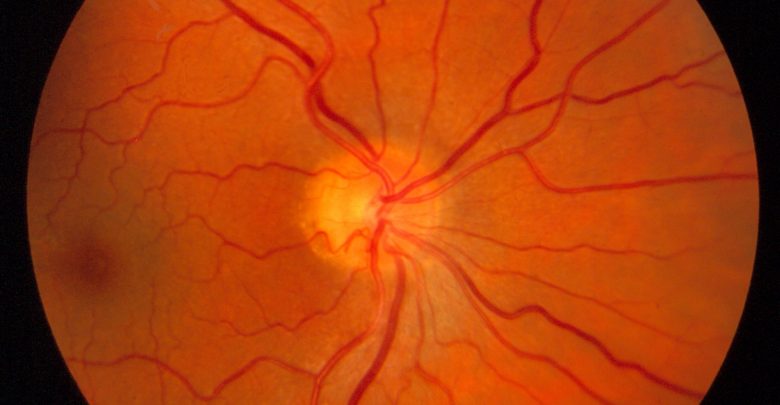 Novel Color Grading Scale Shows Promise as Objective Means of Assessing Optic Nerve