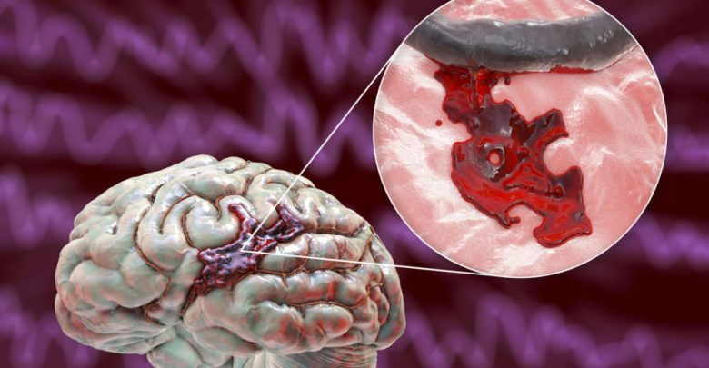 Hemorrhagic-stroke