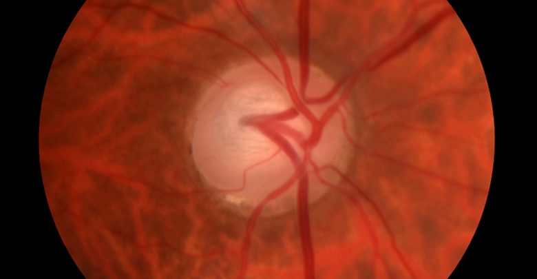 Glaucoma Diagnosis May Increase Tinnitus Risk