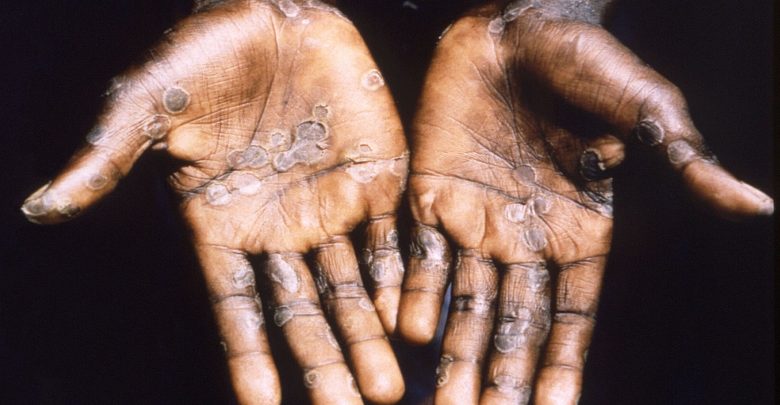 dr Scott Gottlieb says rising monkeypox cases suggest it's spread 'pretty wide'