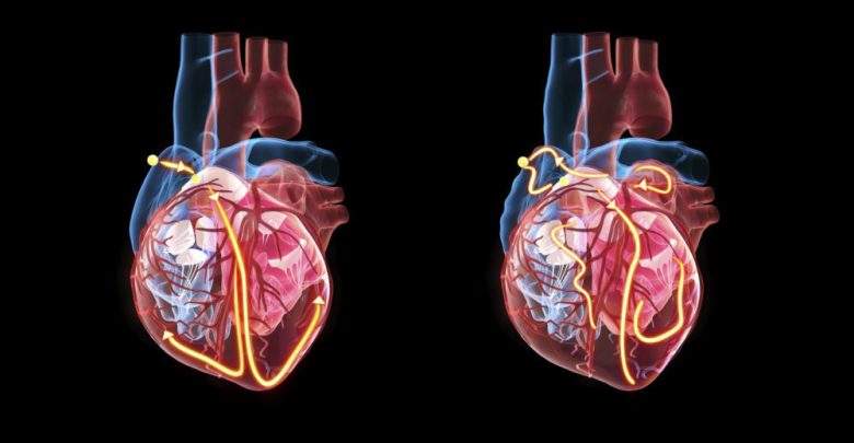 Atrial-Fibrillation