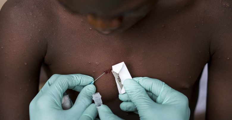 What is Monkeypox and how dangerous is it? Cases are rising globally