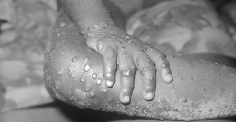 Belgium introduces mandatory monkeypox quarantine as global cases rise