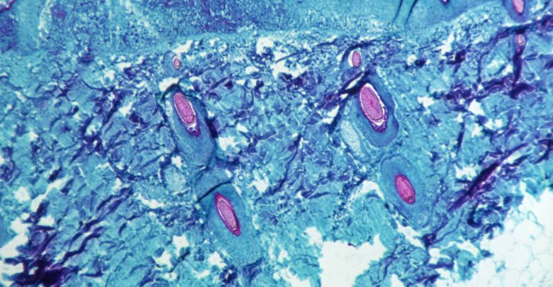 CDC officials sound alarm for gay, bisexual men as monkeypox spreads