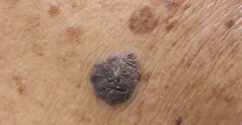 Skin mole
