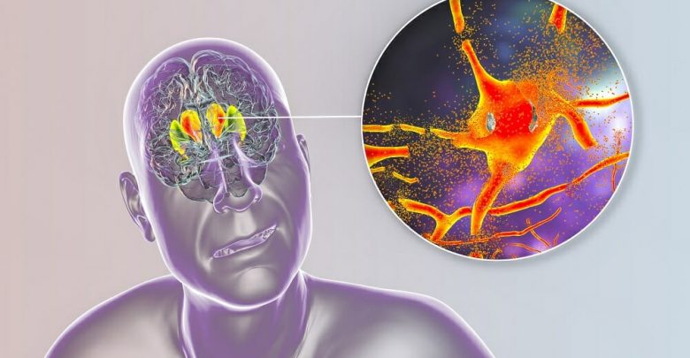 Huntington-Disease