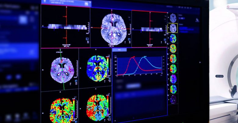 New imaging method may predict risk of post-treatment brain bleeding after stroke