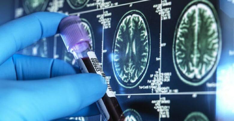 Alzheimer-Blood-Biomarker