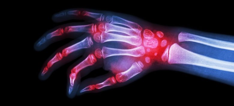 Short Sleep Duration Causally Linked to Rheumatoid Arthritis