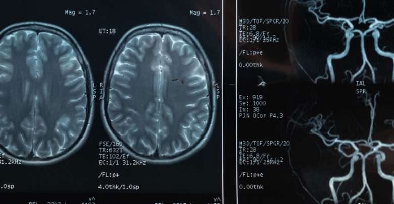 New study finds pulsed MRI system could deliver drugs to the brain