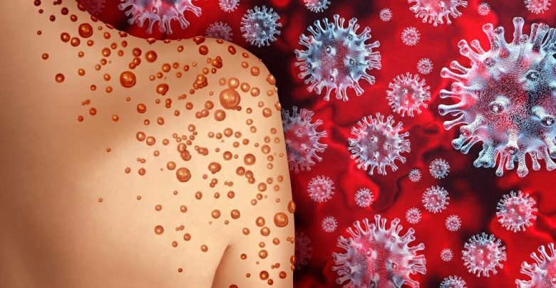 Monkeypox-Illustration