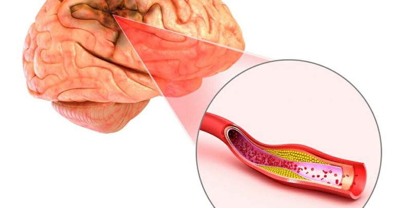 Ischemic-Stroke