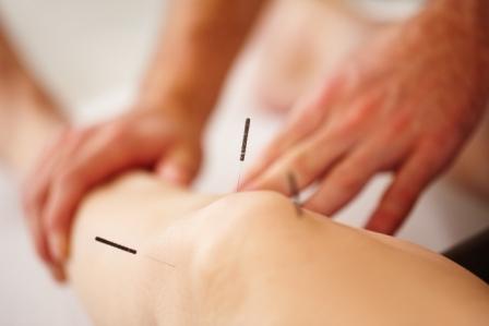 knee, acupuncture, TKR