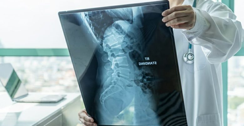 Should Treatment for Spinal Muscular Atrophy Be Initiated Earlier?