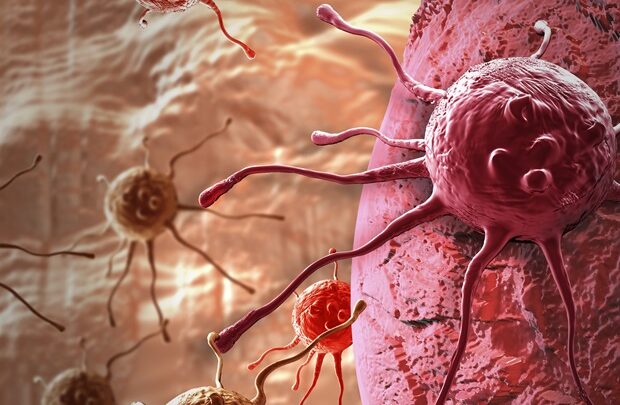 Experts provide first framework for treating hypercalcemia of malignancy in adults