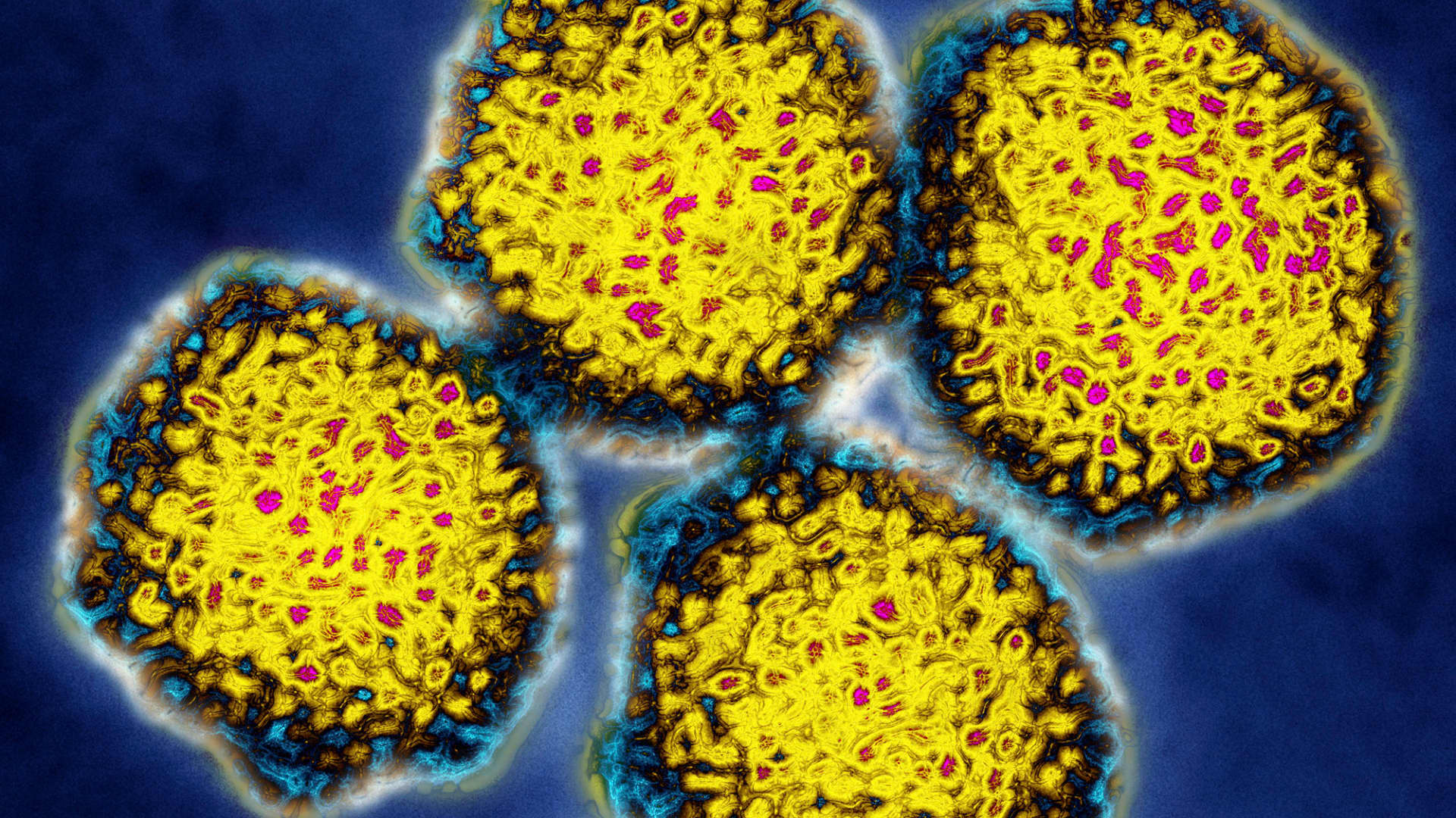Hepatitis C cure isn't reaching patients due to cost, CDC says