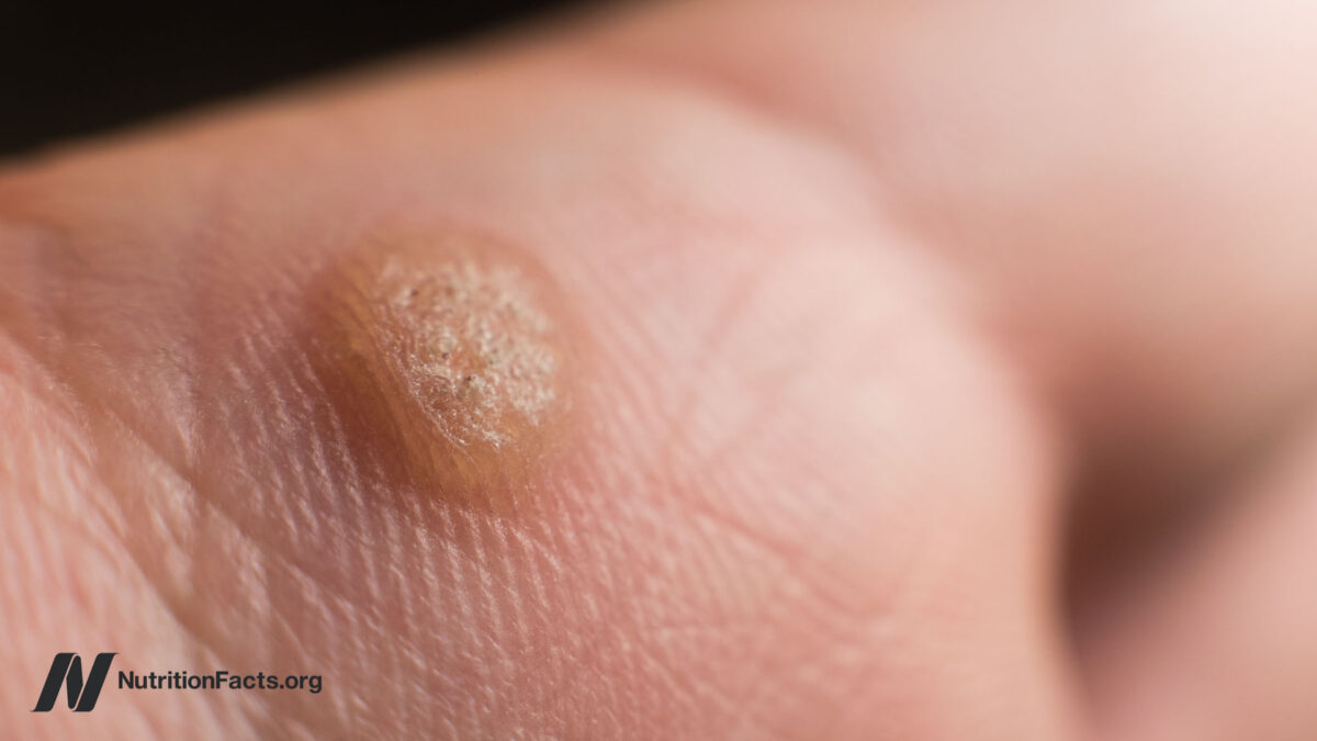 Should We Remove Warts with Duct Tape? 