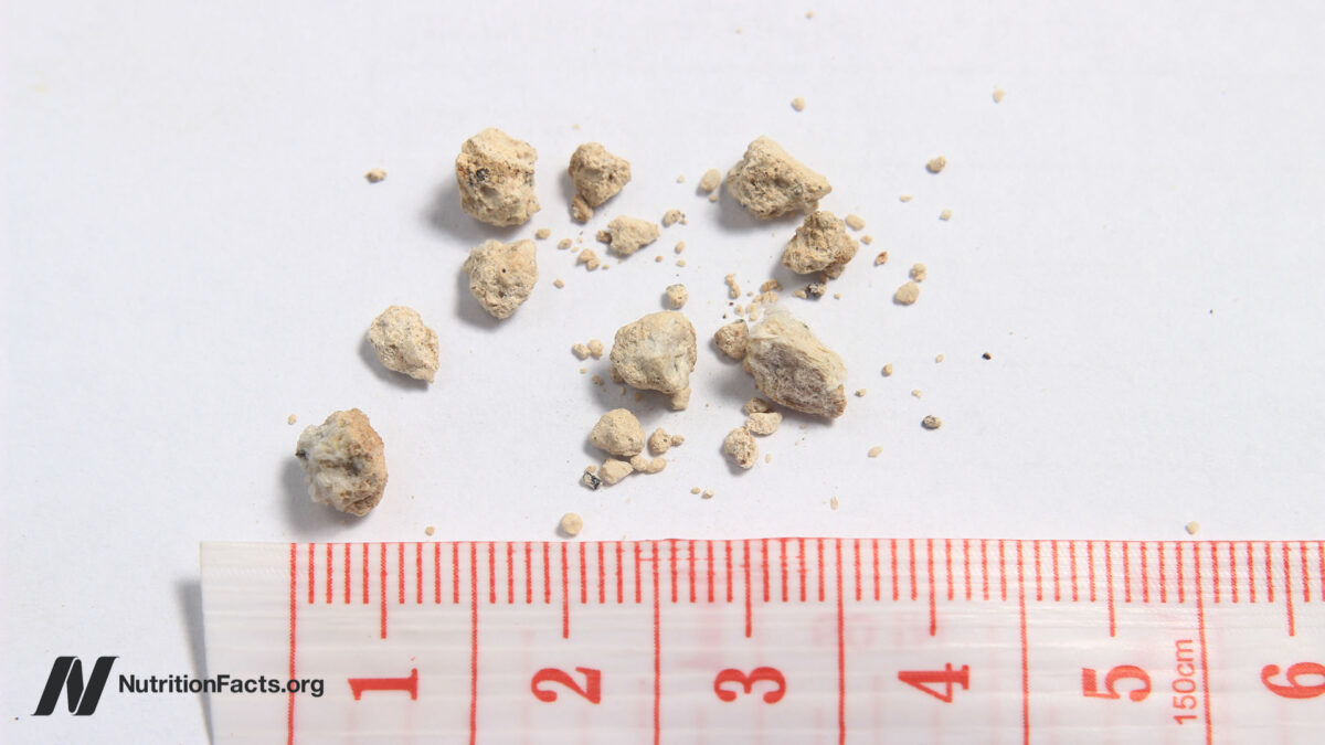 High Oxalate Greens and Kidney Stones 