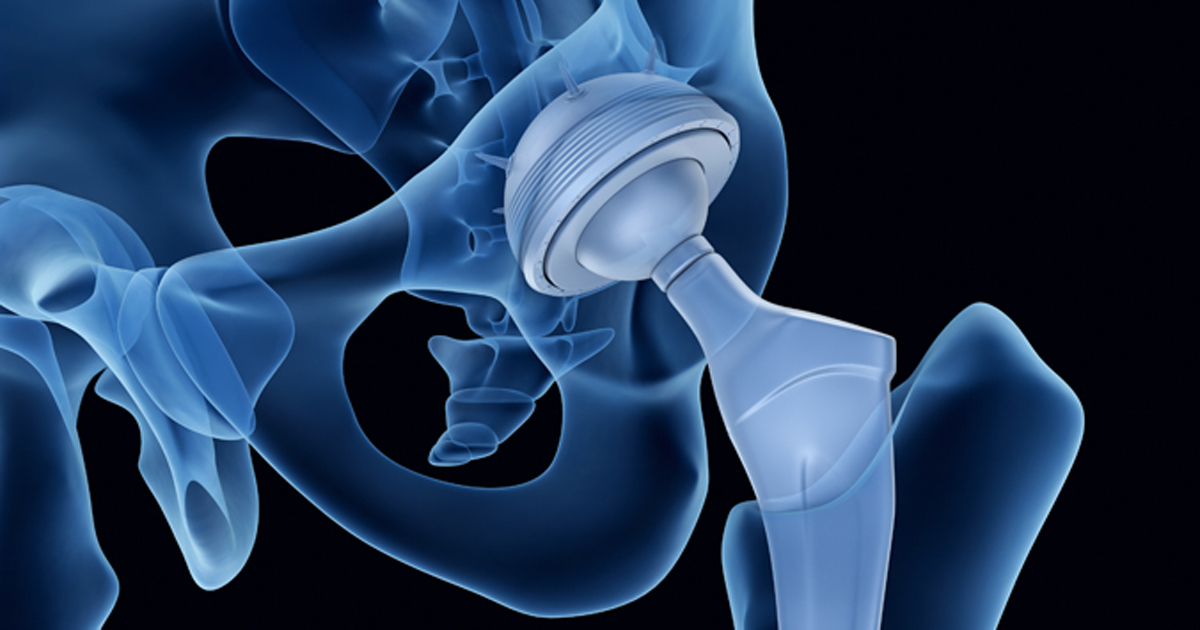 hip replacement_Xray_512529526