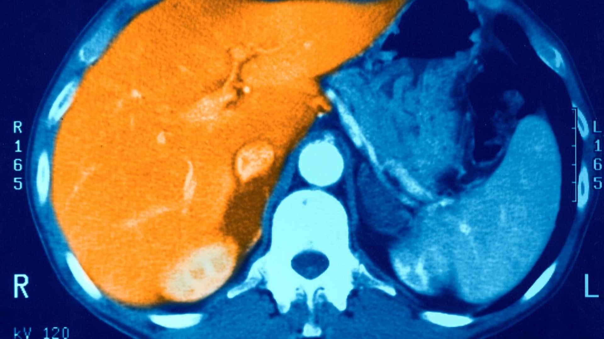 Liver disease is newest weight loss drug use