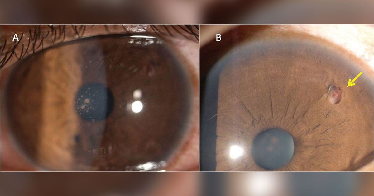 Clinical slit lamp photograph showing endothelial pigmented keratic precipitates
